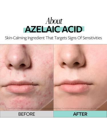 RECIPE Azelaic Acid 10 Soothing Ampoule - Soothing Serum Facial Serum for Sensitive skin - Korean Skincare for Mild Breakouts (1.01 fl oz) - Buy Online on GoSupps.com