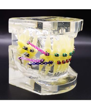 Dental Typodont Orthodontic Teeth Model with Metal Braces & Ligature Ties - Buy Online on GoSupps.com