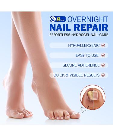 Patchs pour les Mycoses des Ongles (21 pi ces) Traitement et R paration des Mycoses des Ongles des Pieds Multi-usages pour les Ongles pais Fissur s et D color s Soin et R paration des Ongles Ab m - Buy Online on GoSupps.com