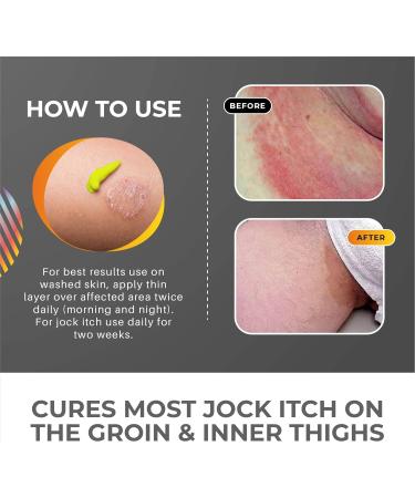 Skin Hero Jock Itch Treatment Cream for Men & Women - Antifungal Formula - 50ml - Buy Online on GoSupps.com
