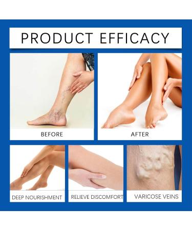 FRTG Varicose veins cream varicose veins with blue light laser treatment pen 1 treatment with blue light laser 1 Varicose Vein Soothing Cream treatment of varicose veins on the legs - Buy Online on GoSupps.com