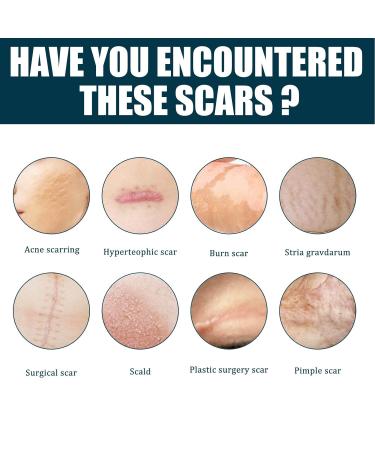 Scar Removal Cream Set | Vitamin E Gel for Stretch Marks | 2Pcs 50ml Belly & Body Oil Cream | Marks Remover - Buy Online on GoSupps.com