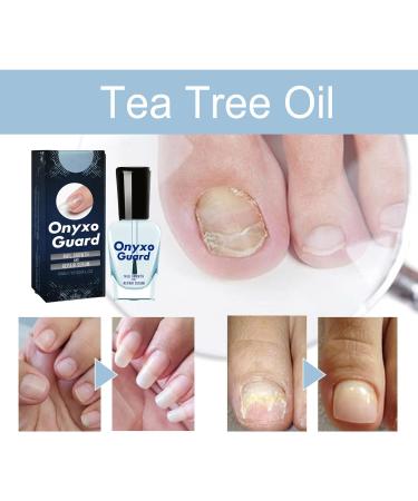 Biancat OnyxoGuard Nail Growth and Repair Serum OnyxoGuard Serum Nail Growth Serum Nail Growth and Strengthener Nail Serum Repair Essence Nail Strengthener for Thin Nails and Growth (1pcs) - Buy Online on GoSupps.com