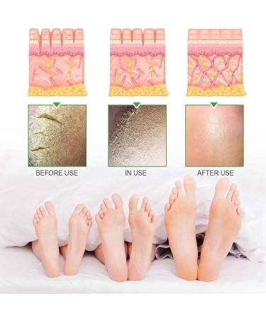 Urea Foot Cream Urea 42% Foot Cream Foot Moisturiser Feet Cream For Dry Cracked Skin Hard Skin Remover Heel Cream 42% Urea Cream & 2% Salicylic Acid Dry Feet Cream Cracked Heel Repair Cream Foot Balm - Buy Online on GoSupps.com