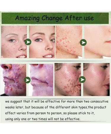 Acne Cream Moisturiser Face Cream Spot Cream Mens Moisturiser Tea Tree Cream Spot Cream For Acne Cream Moisturiser for Women Men Teenagers Dilute Face Prone Spot Marks Balance Facial Oil Cream - Buy Online on GoSupps.com