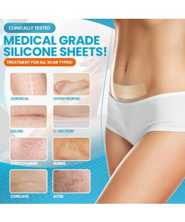 WONDERSCAR 10 Large Silicone Scar Sheets - Medical Grade Treatment for Keloid, C-Section, Burn, Stretch Marks & Acne - Reusable Gel Strips for Scar Removal - Buy Online on GoSupps.com