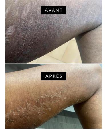  G n rique Super Effective Stretch Mark Peel Black Soap 100g - Buy Online on GoSupps.com