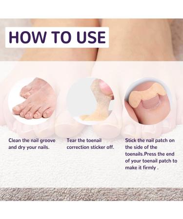 Grgowe Nail Correction Ingrown Toenail Corrector Foot Toenail Plasters Foot Correction Foot Toenail Correction for Care of Toenail Treatment Protect - Buy Online on GoSupps.com