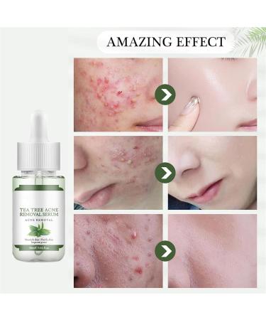 S rum visage anti-acn ingr dients naturels pour une peau professionnellement nette limine les marques d'acn les boutons et r pare la peau hydrate et resserre les pores (1pc) - Buy Online on GoSupps.com