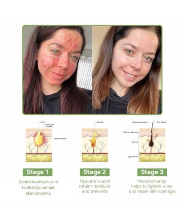 Bee Venom Multi-Purpose Skin Treatment Cream Powerful All-Body skin Cream Intensive skin care and wrinkle reduction (1PC) - Buy Online on GoSupps.com