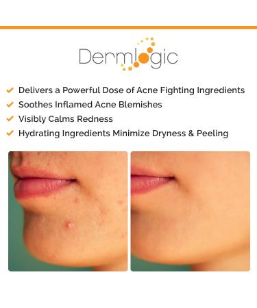 Acne Spot Treatment for Whitehead & Blackhead Pimples - Overnight Solution for Cystic Breakouts. Clears Severe to Mild Blemishes. Alcohol-Free Formula for Teens & Adults - Buy Online on GoSupps.com