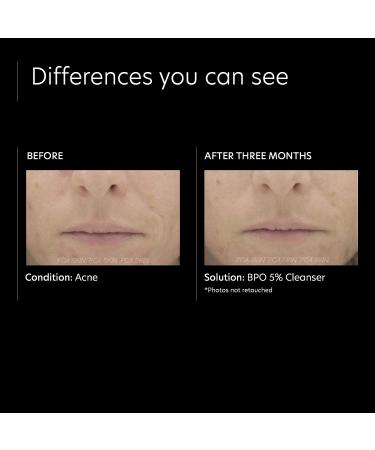 PCA SKIN 5% Benzoyl Peroxide Facial Cleanser - Foaming Face Wash for Oily/Acne-Prone Skin - Non-Drying Formula - 7 fl oz - Buy Online on GoSupps.com