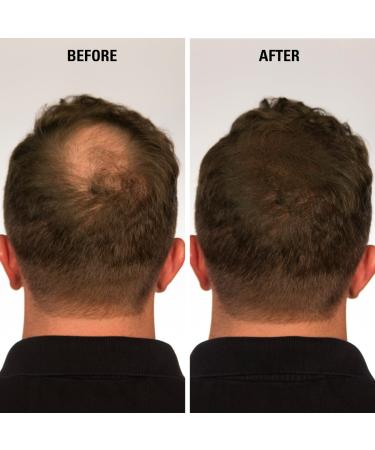 Infinity Hair Fiber - Hair Loss Concealer for Men & Women - Dark Brown 30g - Buy Online on GoSupps.com