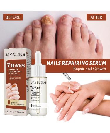 GFOUK 7 days Nail Growth and Strengthening Serum for Thin Nails Nail Growth and Strength Serum Nail Cuticle Oil Strengthener Stronger Nails in 1 Week Nail Strengthening Treatment (2 pcs) - Buy Online on GoSupps.com