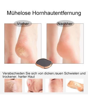 2-in-1 Nano Glass Callus Remover Extremely Effective Callus Removal by Callus Remover for Foot and Hand Callus File for Perfect Foot Care Wet and Dry for Women or Men - Buy Online on GoSupps.com