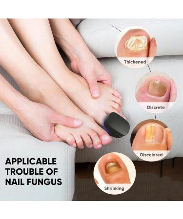 Buy Nail Fungus Light Device for Home Use - Treat Onychomycosis on Fingernails & Toenails | Effective for Damaged Discolored & Thickened Nails - Buy Online on GoSupps.com