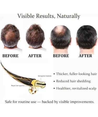 Solution de repousse capillaire par micro-aiguilles s rum de croissance capillaire par micro-aiguilles pointes fourchues lisses frisottis r duits force et paisseur 1pcs - Buy Online on GoSupps.com