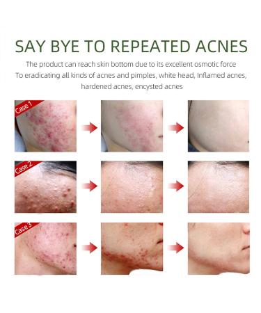 Effective Acne Treatment Face Cream | Herbal Spot Treatment for Teens & Adults | Remove Acne Marks & Moisturize Skin - Buy Online on GoSupps.com