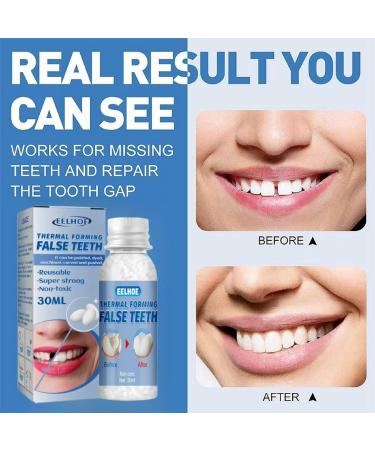 Temporary Tooth Filling Kit for Missing or Broken Tooth Repair | Moldable False Teeth Replacement Solution - Buy Online on GoSupps.com