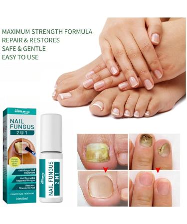 2 IN 1 Nail Fungus Treatment Oil - Fast Relief for Toenail Paronychia & Fungal Infections - Buy Online on GoSupps.com