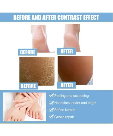Urea 40% Foot Cream Cracked Heel Repair Cream Foot Cream for Cracked Heels and Dry Skin Cracked Heel Repair Cream Urea Foot Cream Foot Moisturiser Skin Care Hands & Feet Cracked Heel Cream Heel Repair - Buy Online on GoSupps.com
