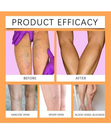 DAPANGGE Turmeric Varicose Vein Patch Turmeric Varicose Vein Patches Varicose Veins Patch Relief Varicose Veins Treatment Patch Naturally Relieves Varicose Veins in Legs and Spiders One Box - Buy Online on GoSupps.com