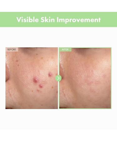 NATUREKIND Acne Deep Cleansing Foam, Formulated with Salicylic Acid for Acne Prone Skin, Daily Acne Face Wash for Removing Sebum and Dead Cells, Korean Skin Care, 100ml, 3.38 fl. oz. - Buy Online on GoSupps.com