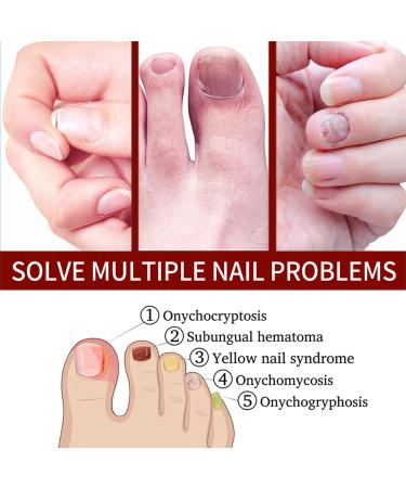 Fungal Nail Treatment - Nail Fungus Treatment For Toenail - Extra Strong Toe Nail Fungal Treatment - Anti fungus Nail Repair and Strengthen Fix & Renew Damaged Broken Nails - Buy Online on GoSupps.com