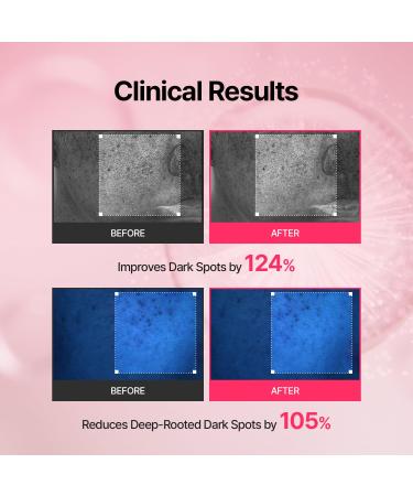 Arbutin Skin Booster Serum with Device + Tranexamic Acid Skin Booster Cream - Korean Face Serum with 10% Niacinamide and 2% Arbutin & 3% TXA - Home Face Massage Tool - Boosts Skin Absorption by 770% - Buy Online on GoSupps.com