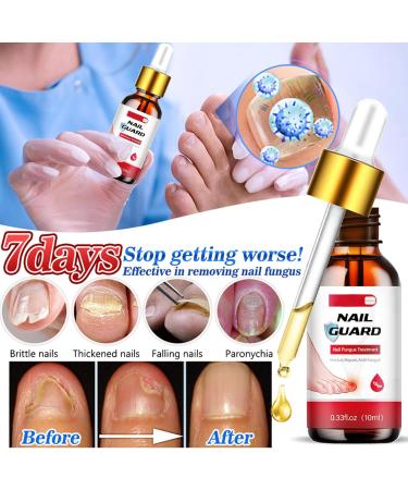 Nail Fungus Treatment for Toenail - 7 Day Fungal Nail Treatment for Toenails Extra Strong - Fungal Nail Treatment - Toenail Fungus Treatment for Thickening Yellow-Brown Discoloration Ragginess 10ML - Buy Online on GoSupps.com