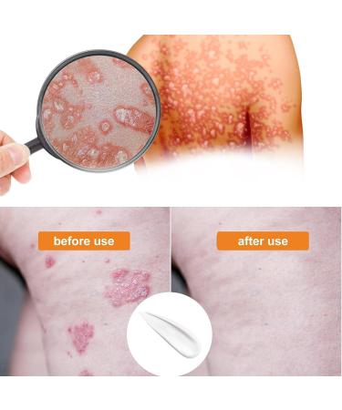 Bee Venom Psoriasis Treatment Cream - Soothing and Moisturizing Skin Relief - 3PCS - Buy Online on GoSupps.com