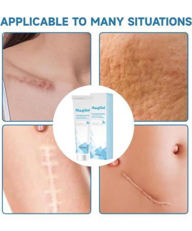 MagiForeign Scar gel scar cream scar removal cream acne scars healing gel for scars surgical scar cream keloid scars acne old and new scars - Buy Online on GoSupps.com