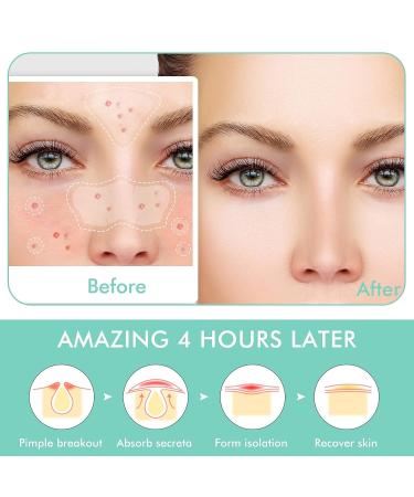 Mandabloom Acne Patch with Tea Tree & Calendula Oil | 104 Dot & Nose/T-Zone Patches | Acne Absorbing Cover for Face, Chin, Body - Buy Online on GoSupps.com