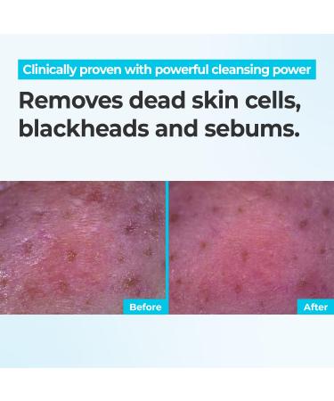 Rbfy. Bubble Clear Foaming Wash - Korean Daily Gentle Cleanser with Micro-Bubble | Salicylic Acid & Plant Extracts for Acne-Prone Skin Deep Pore Cleaning & Exfoliation | Korean Skincare (5.24 fl oz) - Buy Online on GoSupps.com