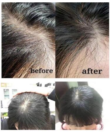 Symeas Hair Regrowth Serum Derma Scalp Intensive Ampoule Triple Roll Massager Scalp Revitalizer Anti Hair Loss Thinning Balding Hair Treatment Essential Oil - Buy Online on GoSupps.com