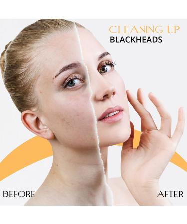 Schamberg Comedone Blackhead Extractor & Remover Tool | Acne Treatment | Facial Tools for Men and Women | 100% Stainless Steel - Buy Online on GoSupps.com