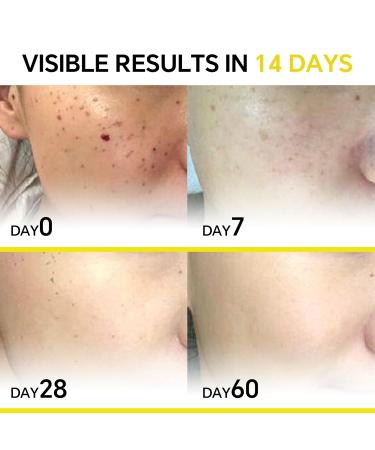 Dark Spot Corrector with 10% Azelaic Acid & Niacinamide | Acne & Rosacea Treatment | Pore Refining & Redness Relief - Buy Online on GoSupps.com