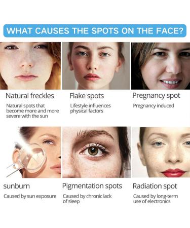 IZBEAUVO Dark Spot Remover for Face and Body Freckle Removal Cream Pigmentation Removal Cream Dark Spot Corrector Cream for Sun Spots Melasma Freckle Dark Spot Sun Spot Age Spot - Buy Online on GoSupps.com