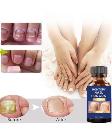Durcisseur et fortifiant pour Ongles | Mycoses Solution Extra Forte pour Les Ongles - Patchs pour Ongles Anti-fongiques pour Le renouvellement des Ongles Force maximale pour Les - Buy Online on GoSupps.com