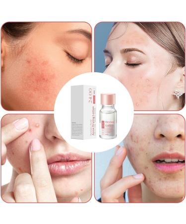 Spot Lotion 10 ml Drying Solution for Spots and Moisturizers | Fast-Acting Liquid for Facial Blemishes for Women for Daily and Nighttime Use Travel and - Buy Online on GoSupps.com