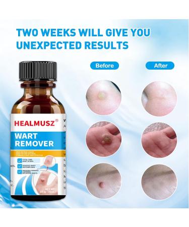Fast Action Liquid Wart Remover - Natural Formula for Warts & Corns | Plantar Common & Flat Wart Treatment | Shop Now - Buy Online on GoSupps.com
