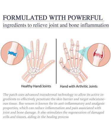 Cvreoz Bienengift Spray & Lotion - Effective Wart Removal Treatment | Shop Internationally - Buy Online on GoSupps.com