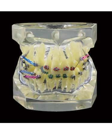 Dental Orthodontic Demonstration Model - Arch Wire Metal Bracket for Teaching & Study (Clear) | International Shipping - Buy Online on GoSupps.com