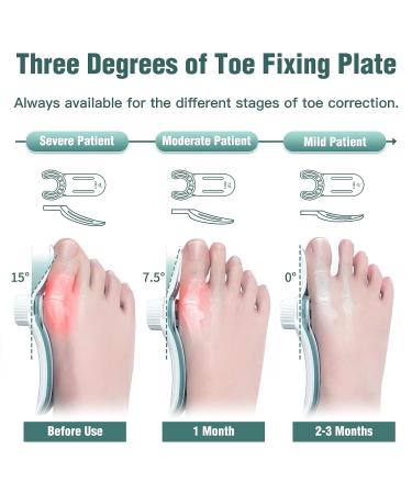 Bunion Corrector for Women & Men - Orthopedic Toe Straightener & Splint for Hallux Valgus - Bunion Relief Brace with 3 Angle Fixing Plates - Buy Online on GoSupps.com