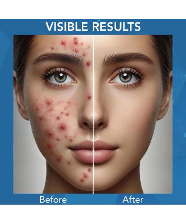 NOVEHA Facial Cleanser For Acne - Hypochlorous Acid Spray - Irritation Redness & Breakouts Relief - Ideal for Active Teenage & Adult Athletes Post-Workout - Safe for Multiple Daily Uses - 8 oz 8 Fl Oz (Pack of 1) - Buy Online on GoSupps.com
