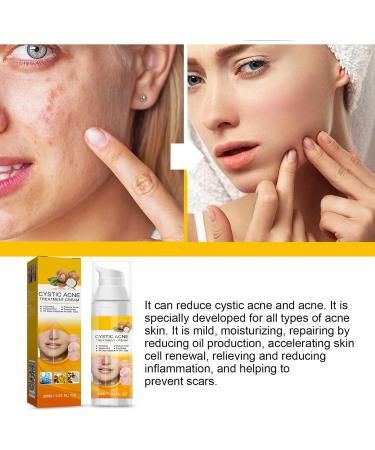 KOAHDE Facial Anti Acne Essence Acne Essence Anti Acne Hydrating Essence Anti Acne Facial Serum Acne Treatment Serum Serum Skin Smoother Acne Removing Moisturizing Serum Skin Rejuvenation Serum - Buy Online on GoSupps.com