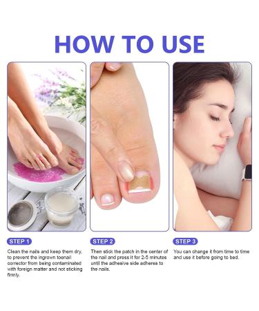 100PCS Ingrown Toenail Corrector Strips - Painless Toenail Correction Patches for Ingrown Toenail Treatment - Buy Online on GoSupps.com