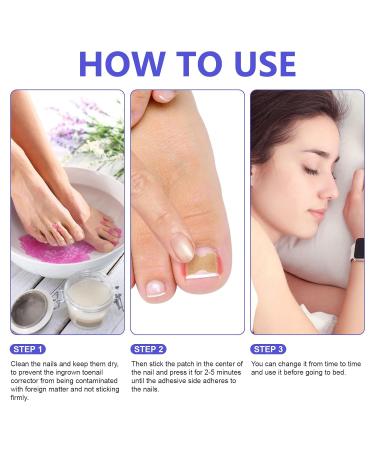 Ingrown Toenail Treatment - Painless Corrector Strips & Nail Correction Patches | 100 Pcs - Buy Online on GoSupps.com