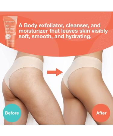 KP Bump Eraser Body Scrub - Exfoliating Strawberry Legs Treatment & Ingrown Hair Solution - Buy Online on GoSupps.com