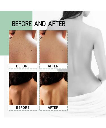 Back Acne Treatment Spray Lighten Acne Marks Skin Care Spray Herbaluxy Back Acne Repair Back Shoulder Acne & Body Acne & Chest Acne & Butt Acne Deep Cleans All Parts of The Body Gentle on Skin - Buy Online on GoSupps.com